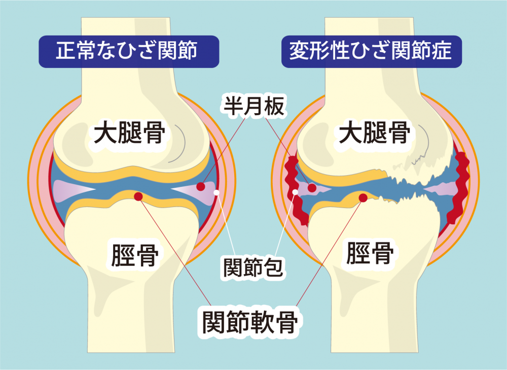 膝関節症改善で意識していることは?