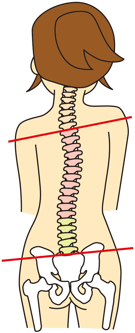 骨盤の歪みは肩こりの原因になります